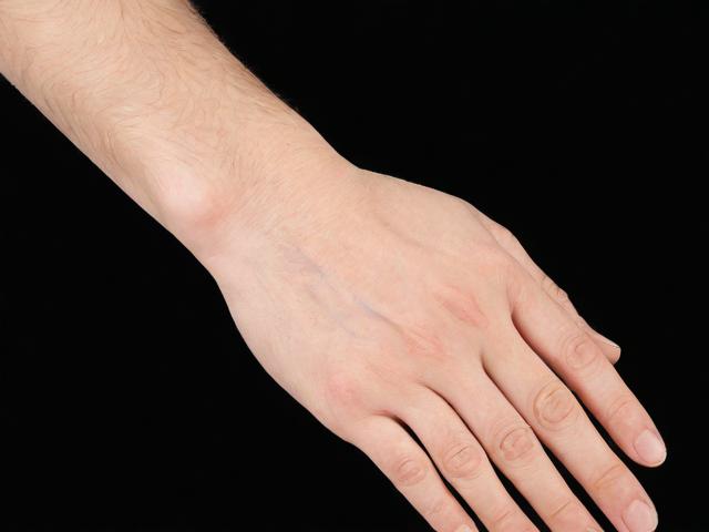 郑州狐臭手术费用解析，郑州腋臭治疗价格全指南