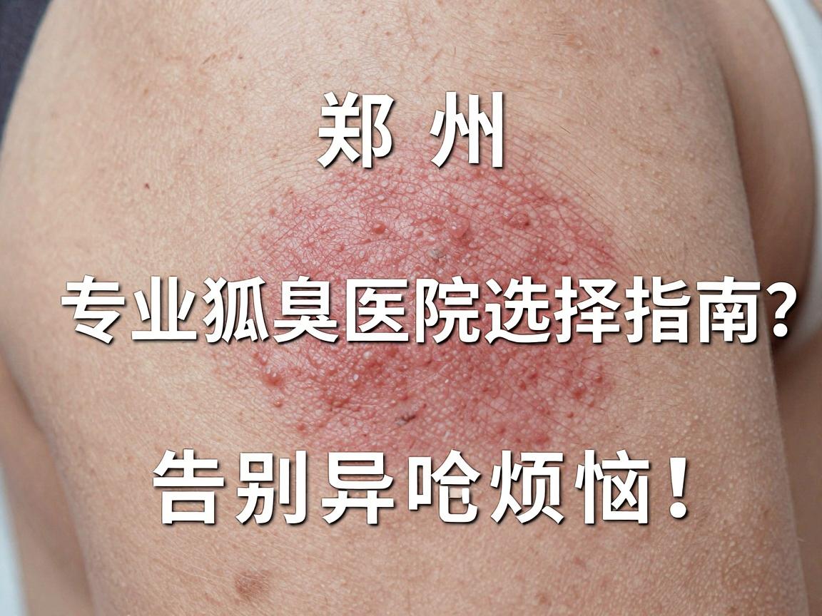 郑州专业狐臭医院是哪家?专业狐臭医院选择指南,告别异味烦恼 郑州专业狐臭医院是哪家?专业狐臭医院选择指南,告别异味烦恼